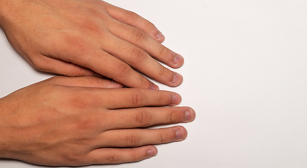 Are You Nutritionally Deficient? Look at Your Nails! -
