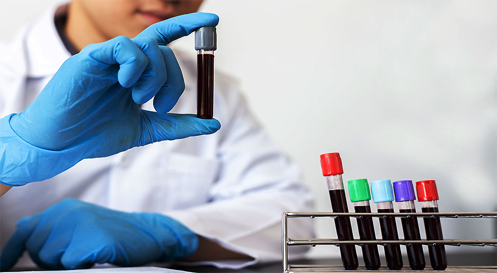Best Blood Test to Diagnose Gluten Sensitivity