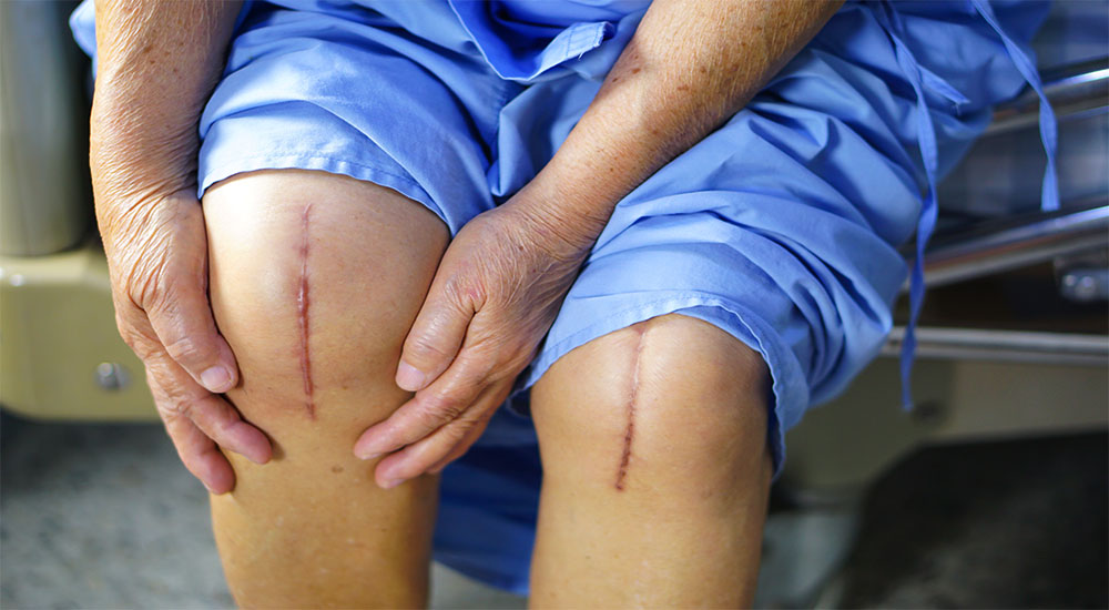 Had a Knee Replacement Why You Need a Physical Therapist