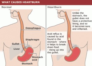 Heartburn Diagram