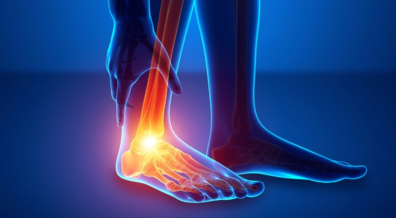 Is Your Pain Due to Plantar Fasciitis? 