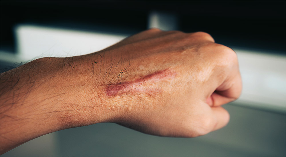 Physical Therapy Helps Scar Tissue