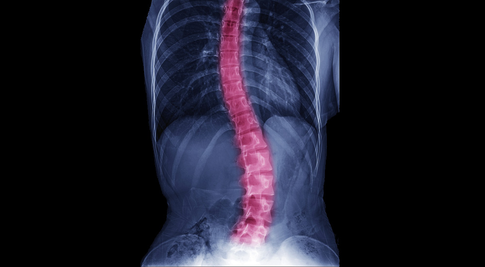 Scoliosis – What You Need to Know