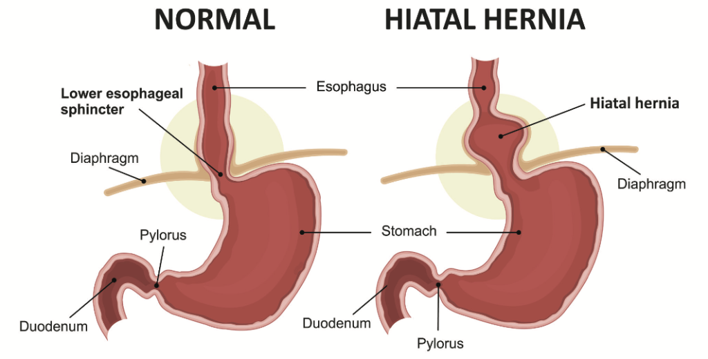 Hiatal Hernia Syndrome and Gluten: Connecting the Dots