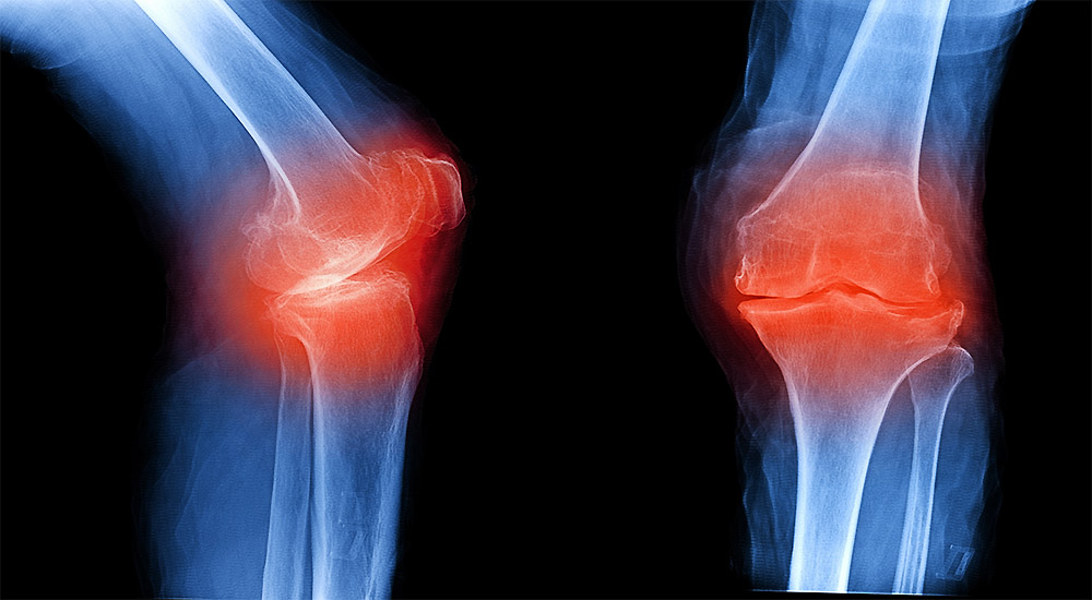 Sore Joints Osteoarthritis What’s the Best Treatment