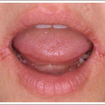 angular-stomatitis_optimized