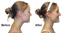 cervical-curve-before_after_optimized