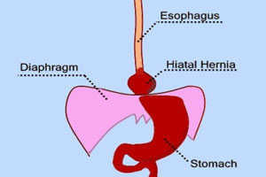 hiatal hernia surgery: who should have it, and what kind of success rate to expect