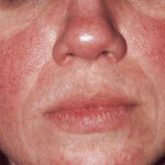 rosacea_optimized